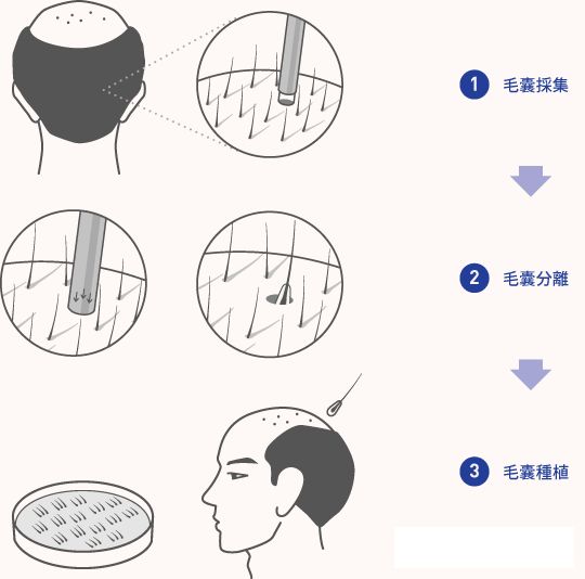 种头发的6大危害,植发前赶紧看看!